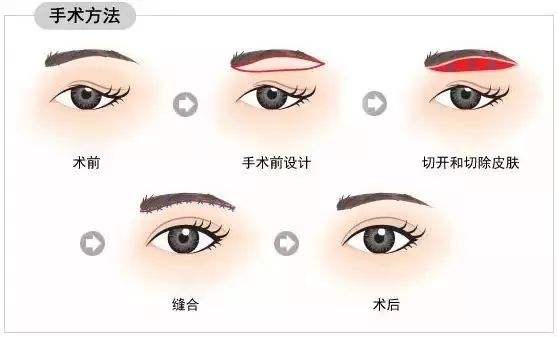 切眉術(shù)適合多大的年齡做？主要能帶來哪些果？