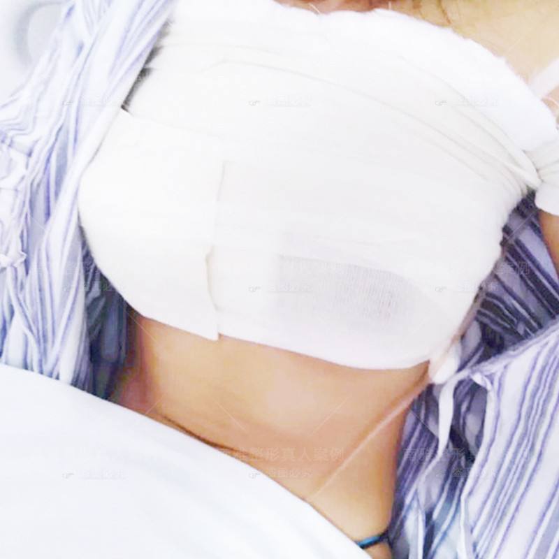 蜜桃假體隆胸自然嗎？會(huì)不會(huì)看著很假？