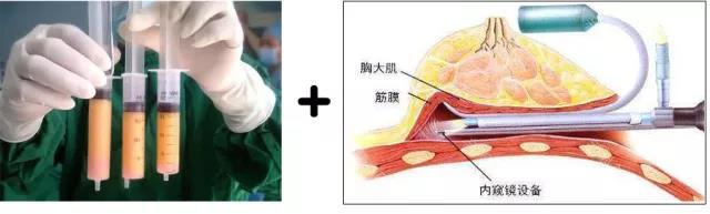 蜜桃假體隆胸自然嗎？會(huì)不會(huì)看著很假？