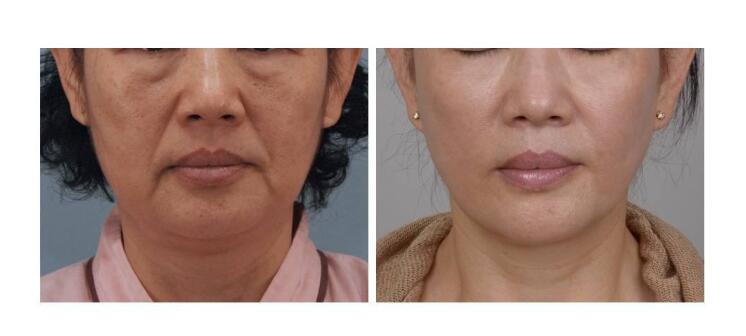 想知道北京面部提升多少錢？看一下詳細(xì)的數(shù)據(jù)