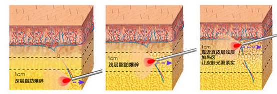 激光溶脂瘦大腿果怎么樣？會(huì)反彈嗎？