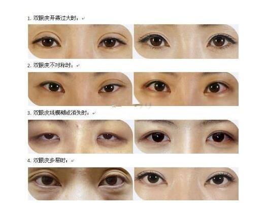 想知道雙眼皮修復(fù)前后能改良哪些問(wèn)題？主要有這些