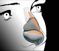 駝峰鼻矯正術(shù)價(jià)格和果圖，參考一下再?zèng)Q定做不做