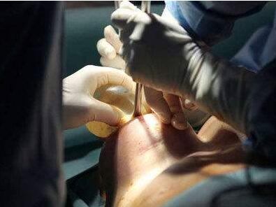 找劉旺醫(yī)生做隆胸手術(shù)，見證了“零出血”，還有微創(chuàng)隆胸等等