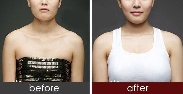 找劉醫(yī)生做隆胸手術(shù)，見證了“零出血”，還有微創(chuàng)隆胸等等