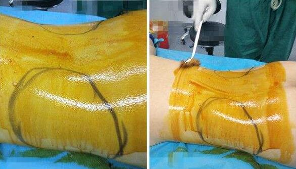 腰部吸脂手術(shù)開始手術(shù)之前，先標(biāo)注好需要抽脂的部位，然后實施麻醉