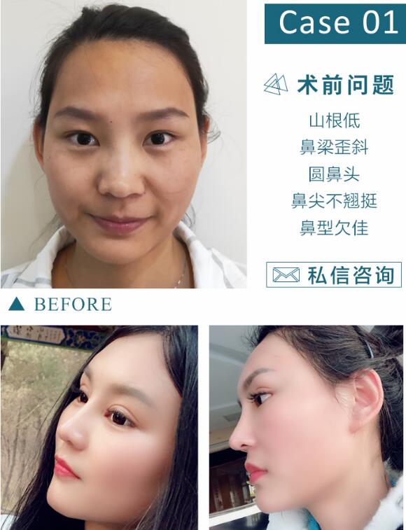 膨體隆鼻恢復(fù)時(shí)間要多久？科普文~