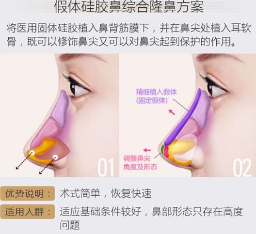 硅膠假體隆鼻好不好？這3點(diǎn)你要知道！