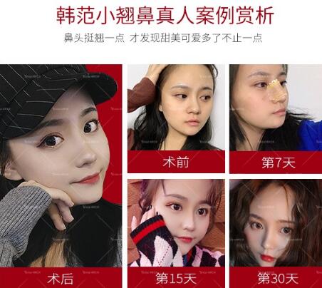 硅膠假體隆鼻好不好？這3點(diǎn)你要知道！