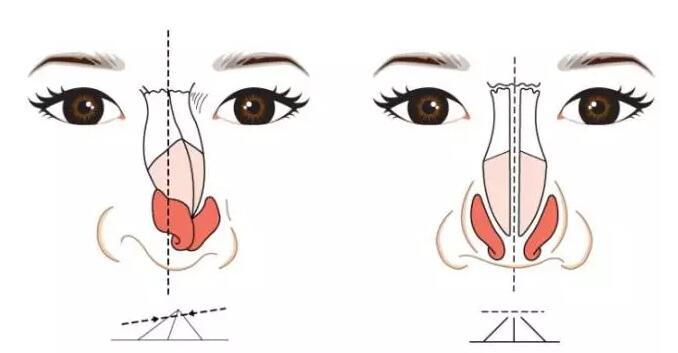 【美麗修行】鼻梁矯正多少錢？