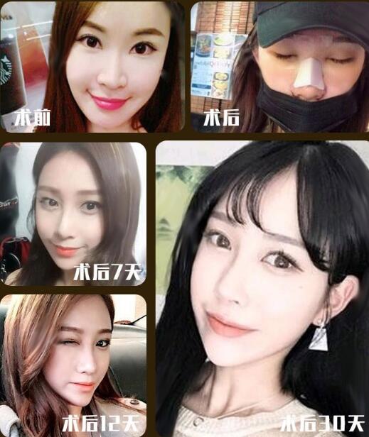 【美麗修行】鼻梁矯正多少錢？