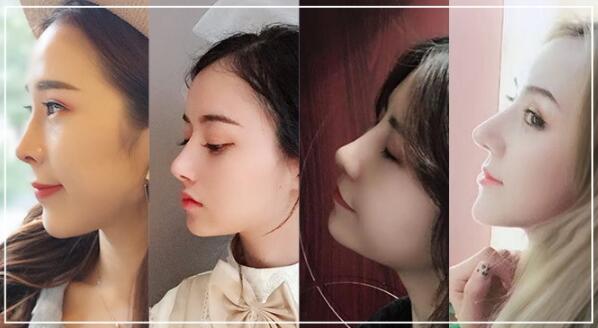 駝峰鼻修復(fù)知識全科普，來看看適合你嗎？