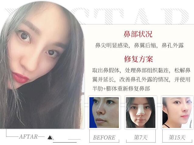 膨體隆鼻后取出假體，手術是這樣做的！