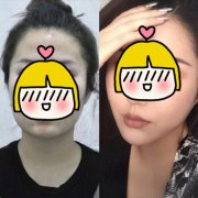 北京面部吸脂經(jīng)歷！價格、果、恢復(fù)期信息都在這里