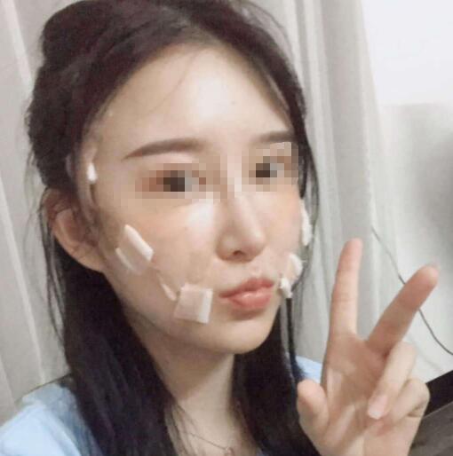 任學(xué)會(huì)脂肪填充案例