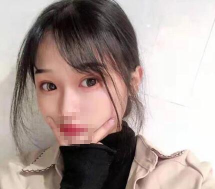 濟南芭莎美恩雙眼皮案例圖