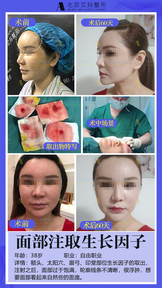 填充以后的不良反應(yīng)，勸你抓緊取出來(lái)