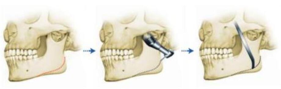 下頜角磨骨手術(shù)的步驟圖