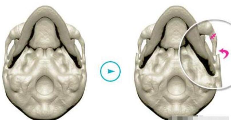 顴骨內(nèi)推手術(shù)主要是調(diào)節(jié)全供和下巴之間的距離