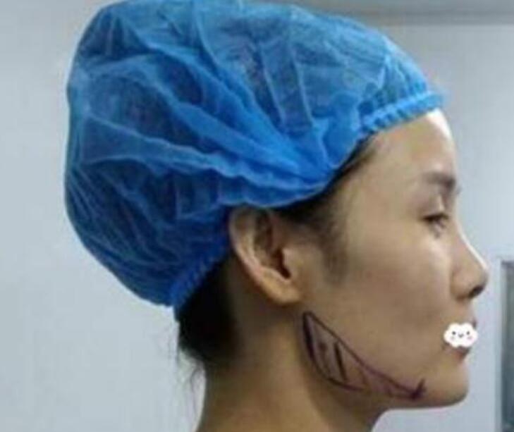 那么，做下頜角磨骨整形術(shù)后什么能吃什么不能吃