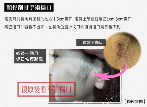 顴骨磨骨手術(shù)，他需要把顴骨附近的肌肉和骨膜分離