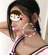 上海首爾麗格下頜角手術(shù)案例，成功擁有“高級臉”！