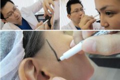 真實案例：下頜角截骨前后果對比果圖分享