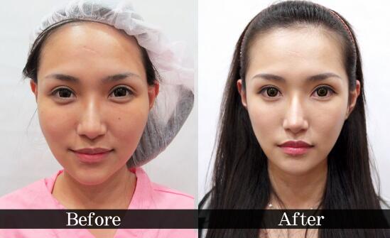 真實(shí)案例：下頜角截骨前后果對(duì)比果圖分享