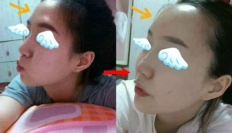 填充前額，需要在手術(shù)前確定整形手術(shù)方案，如假體選擇或自體脂肪填充