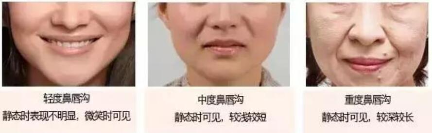 鼻唇溝分為輕度、中度、重度和極度重度