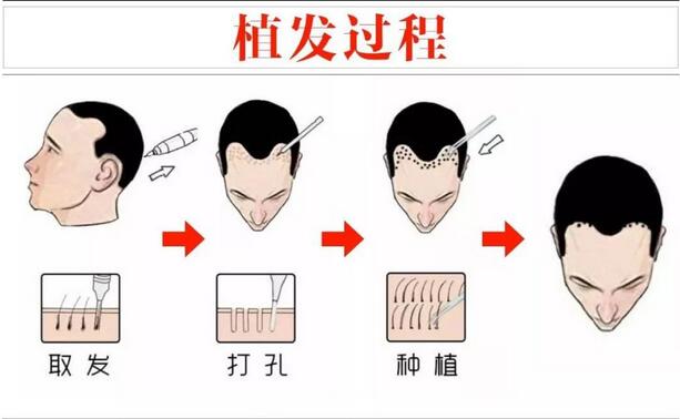 FUE植發(fā)過程圖