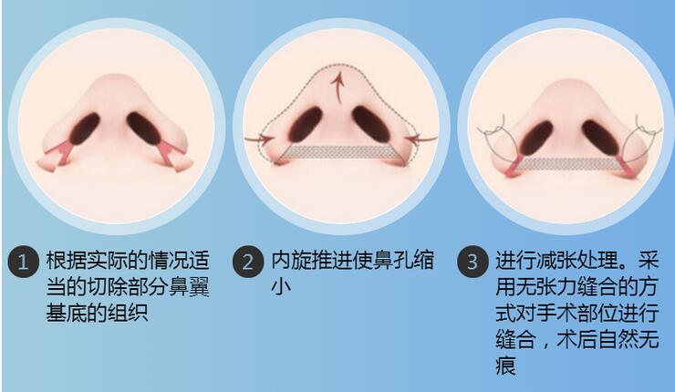 外切手術縮小鼻翼