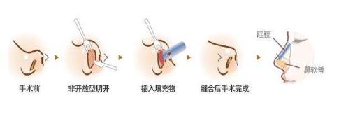 三種軟骨哪個好?