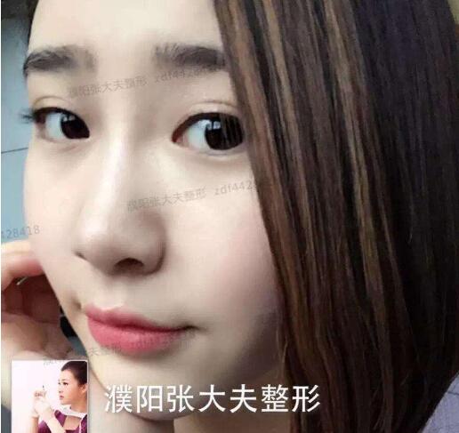 濮陽張大夫整形案例圖