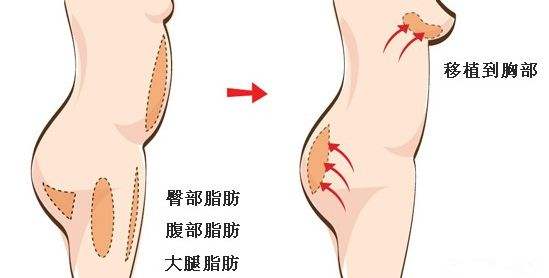 抽脂填胸多少錢？請(qǐng)問(wèn)抽脂填胸需要做二填嗎？