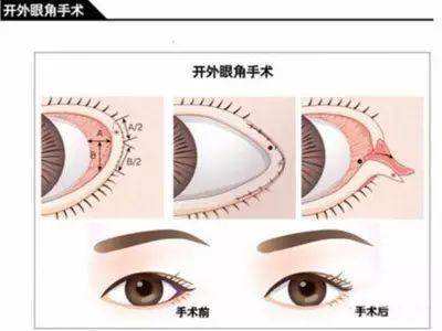 開內(nèi)眼角哪里好？想要做開眼角手術(shù)該如何選擇醫(yī)院