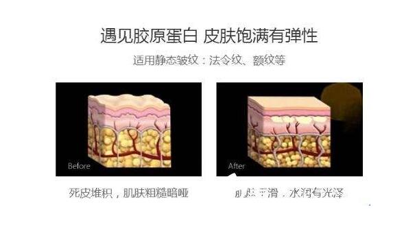 膠原蛋白祛皺果好不好？你還在為皺紋煩惱嗎~