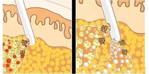 環(huán)形抽脂有什么危害嗎？告別“五花肉”還是抽脂好