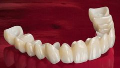 美容冠多少錢一顆？美容冠的缺點(diǎn)讓牙齒成為不可逆的傷害