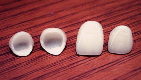 美容冠多少錢一顆？美容冠的缺點(diǎn)讓牙齒成為不可逆的傷害