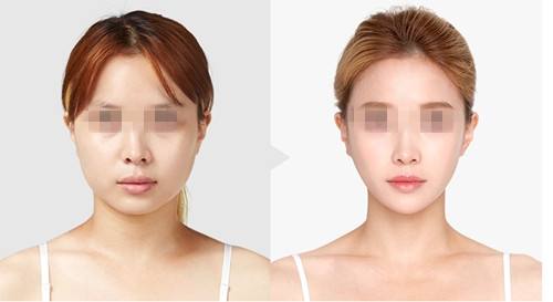 了解到韓國面部提升在當(dāng)?shù)睾芑?，詳細講解一下這個手術(shù)！