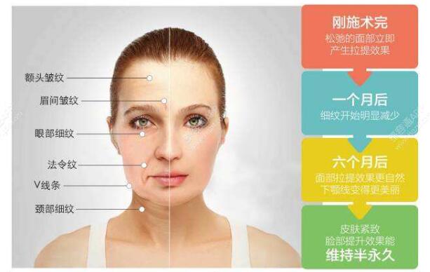 了解到韓國面部提升在當(dāng)?shù)睾芑?，詳細講解一下這個手術(shù)！