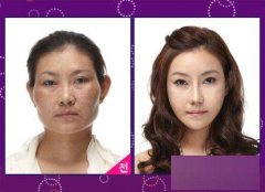 大臉盤(pán)子做削骨要多少錢(qián)？削骨手術(shù)的死亡率大嗎？