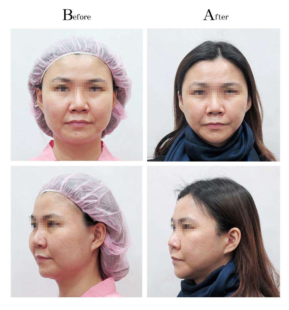 大臉盤子做削骨要多少錢？削骨手術(shù)的死亡率大嗎？