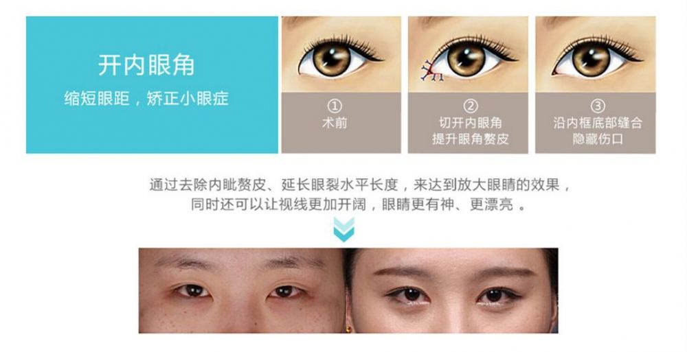 微創(chuàng)開眼角多少錢？盤點一下微創(chuàng)開眼角是什么技術(shù)