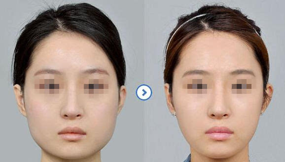 磨骨手術(shù)對比