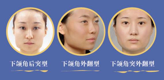 磨下頜角攻略