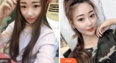 安徽省立醫(yī)院褚燕軍雙眼皮案例反饋，是你喜歡的款式嗎？