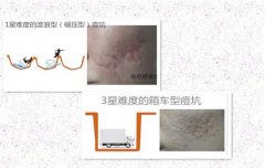 好幾年的痘印做微針痘坑幾次有？祛痘指南請(qǐng)收好