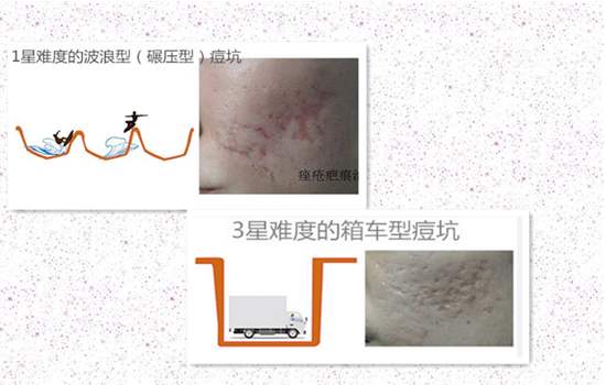 好幾年的痘印做微針痘坑幾次有？祛痘指南請收好